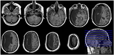 Case Report: Resting-State Brain-Networks After Near-Complete Hemispherectomy in Adulthood